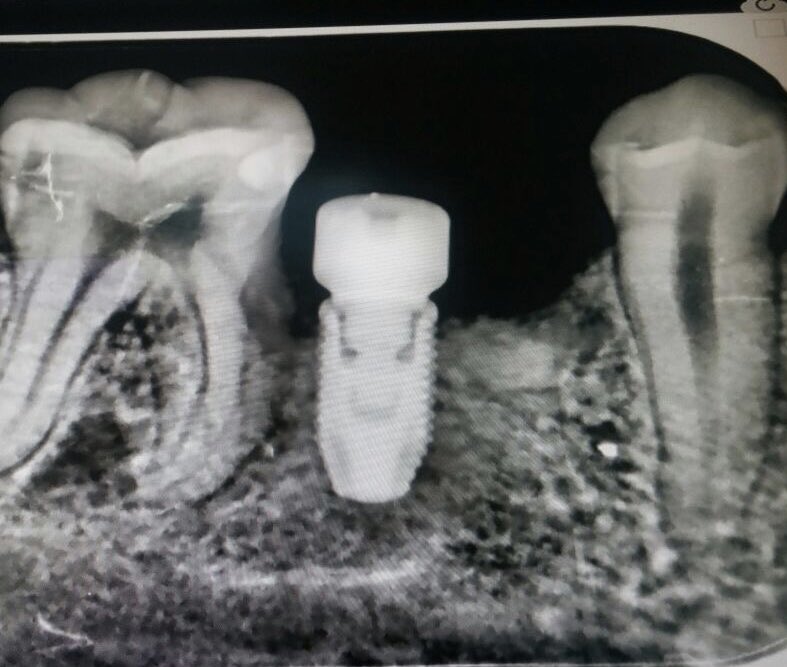 Yerinden oldukça memnun kalmış bir implant