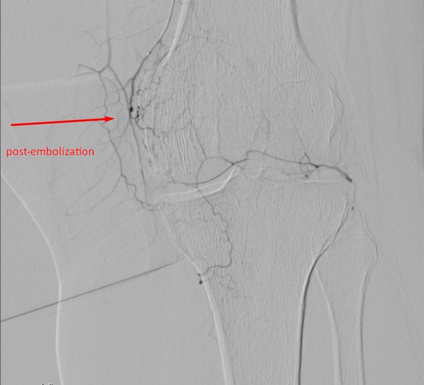 0kanGurkan's tweet photo. Trancathater #genicular #artery #embolization of a patient with osteoarthtritis. Her VAS score dramatically decreased after the procedure. https://t.co/t1cbldJKgG
