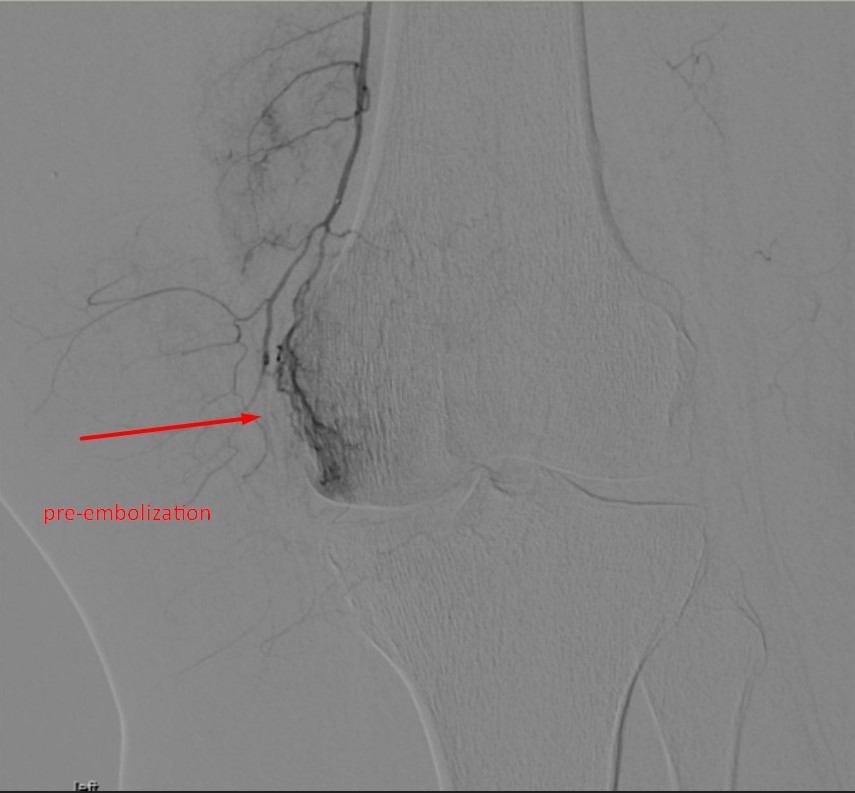 0kanGurkan's tweet photo. Trancathater #genicular #artery #embolization of a patient with osteoarthtritis. Her VAS score dramatically decreased after the procedure. https://t.co/t1cbldJKgG