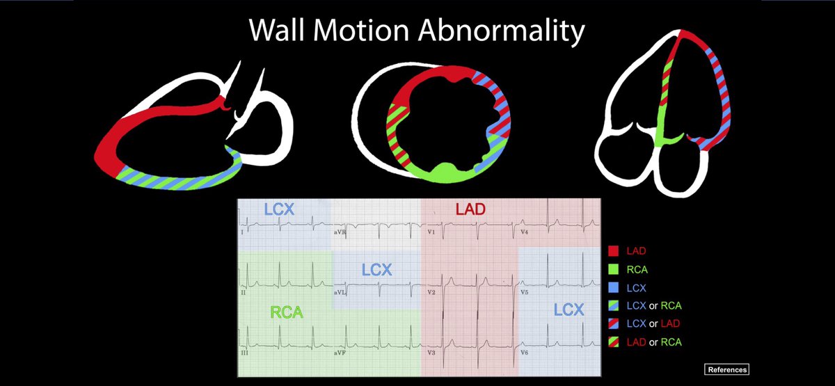 Advanced #echo card from @ACEP_EUS critical care subcommittee on wall motion abnormalities #echofirst #pocus acep.org/emultrasound/s…