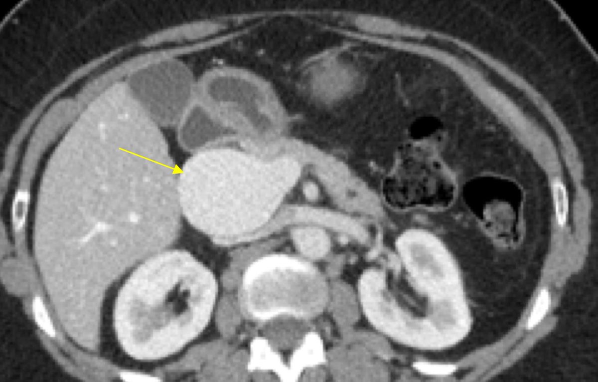 RCC_Editor's tweet photo. Get ready for our #IRad Case-of-the-Week!

What’s the diagnosis in this 69-year-old woman with portal hypertension presenting for an annual wellness check?

https://t.co/mmsgk6lbOc

@SIRspecialists @SIRspecialists @uab_ir #RadTwitter #GIRad #RSNACC https://t.co/agRXciy0BI