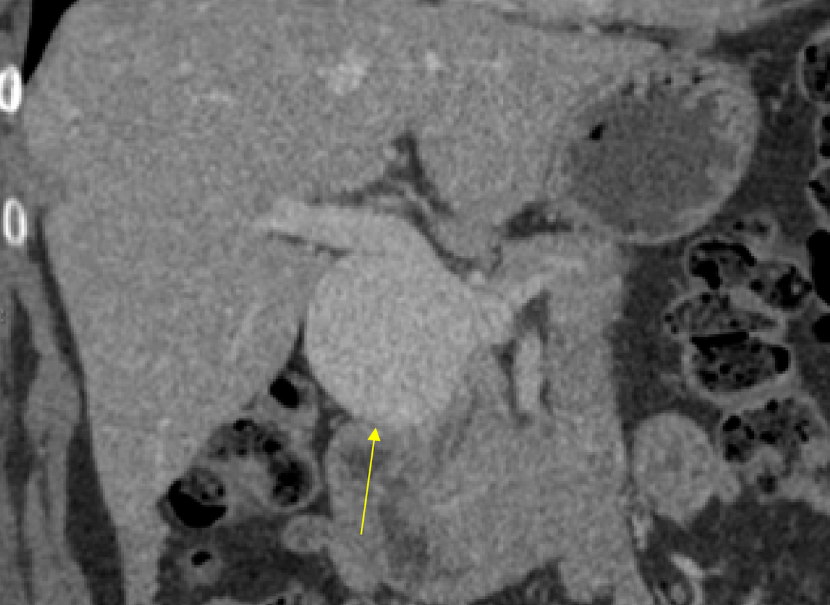 RCC_Editor's tweet photo. Get ready for our #IRad Case-of-the-Week!

What’s the diagnosis in this 69-year-old woman with portal hypertension presenting for an annual wellness check?

https://t.co/mmsgk6lbOc

@SIRspecialists @SIRspecialists @uab_ir #RadTwitter #GIRad #RSNACC https://t.co/agRXciy0BI