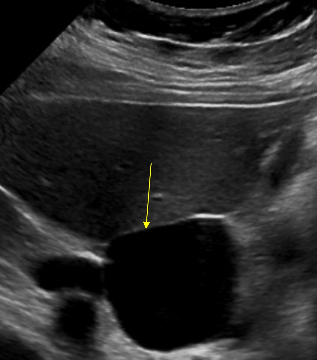 RCC_Editor's tweet photo. Get ready for our #IRad Case-of-the-Week!

What’s the diagnosis in this 69-year-old woman with portal hypertension presenting for an annual wellness check?

https://t.co/mmsgk6lbOc

@SIRspecialists @SIRspecialists @uab_ir #RadTwitter #GIRad #RSNACC https://t.co/agRXciy0BI