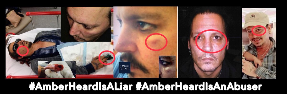 PunkRockFlower's tweet photo. ‘I ran into a door’, ‘I tripped &amp; fell down the stairs’ &amp; ‘I sliced my finger off’.. lies DV victims tell, to hide the abuser.

#ApologiseToAmberHeard? No.

What would the world have done if Depp told them Heard sliced his finger off when she had a tantrum over the prenup? https://t.co/EW9yXuAAkS