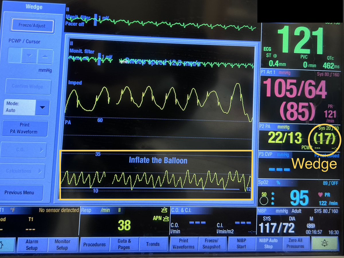 [1] #Hemodynamics Tweetorial #2 Heart failure pt in ICU is -3.5L after 2d of aggressive diuresis. On day 3, urine output is ⬇️and BUN/Cr is ⬆️ You personally wedge #PAC at bedside and obtain a mean wedge 17 mmHg (a normal mean wedge is 6-10 mmHg). Admission wedge was 24