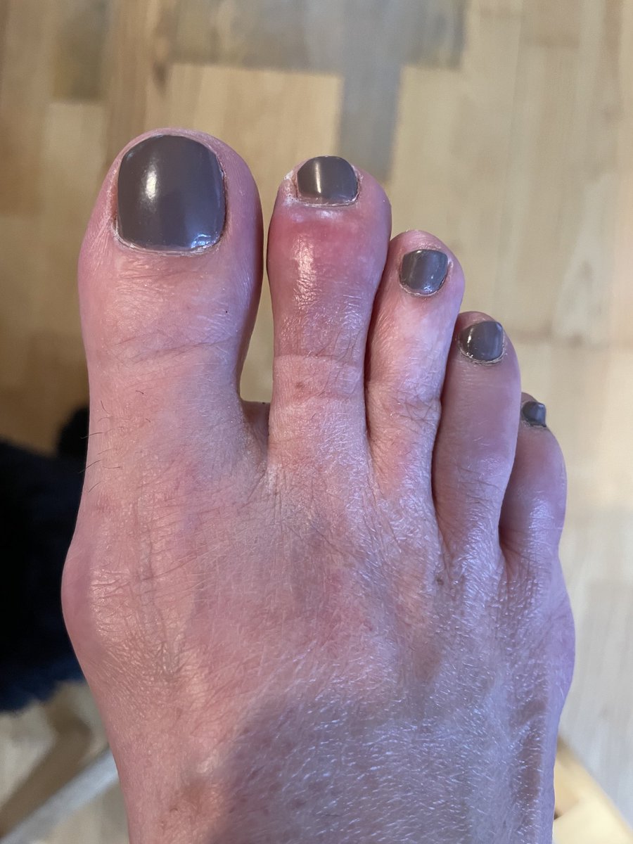 I might have broken a toe yesterday when a glass bottle of Heinz 57 Sauce fell on it at a 5 foot drop but it might only be bruised and I’m a big baby. Yes. That’s the best home pedicure I can do… ( hashtag save your money )