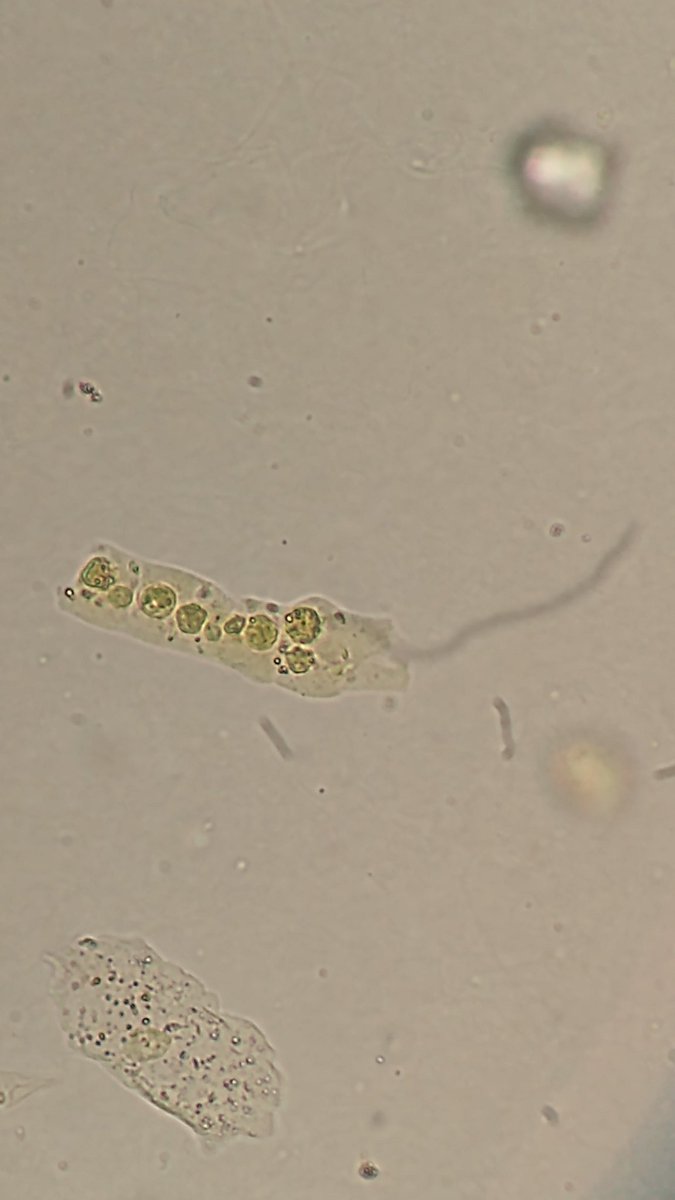 carlosrobertoqr's tweet photo. Cilindro corado pela bilirrubina da urina. Essa urina apresentou cristais de Bilirrubina no sedimento urinário.
#sedimentourinario #urinarysediment #urine #urina #eas #cilindruria #cilindroleucocitario #wbccast https://t.co/y3BqI5oEIZ