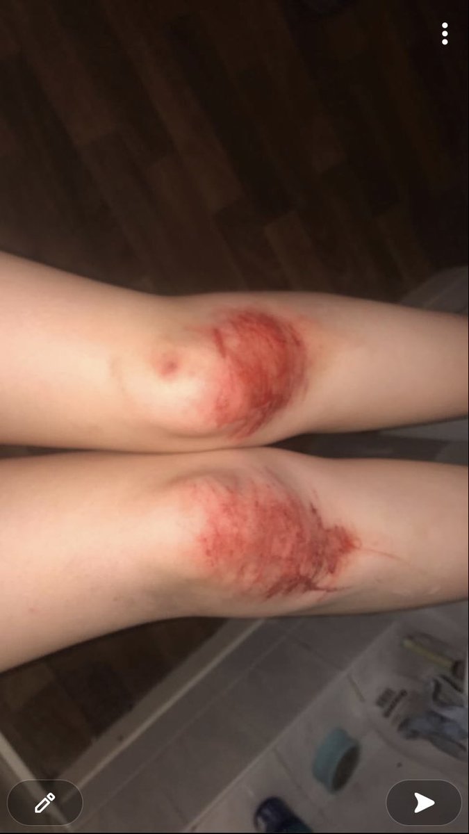 cutmelol's tweet photo. nah its bad when i do my KNEES 😭 

shtwt ouchietwt beanstwt goretwt bloodtwt obslovetwt armgillstwt raspberryfillingtwt styrotwt 198twt https://t.co/Tv7WOiTlkU