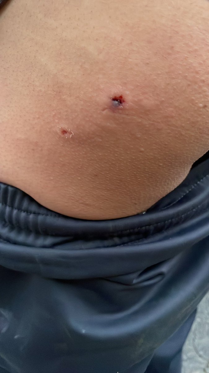 lybra_ali's tweet photo. @UCS_GCDMX,  día de ayer fui atacada por 6 perros  rodando por una ladera solo tengo contusiones por la caída pero al  apoyarme mi esposo fue mordido y atacado  por los mismos perros, donde puedo hacer mi denuncia https://t.co/RLRF0AhPEq