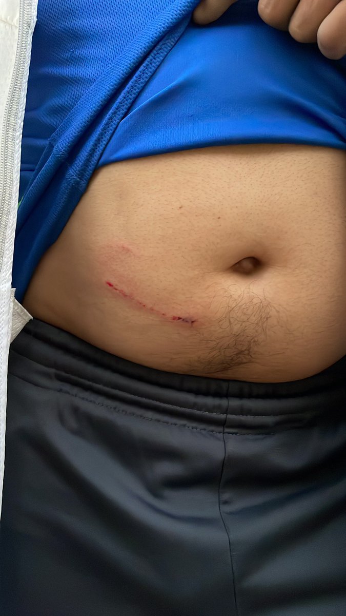 lybra_ali's tweet photo. @UCS_GCDMX,  día de ayer fui atacada por 6 perros  rodando por una ladera solo tengo contusiones por la caída pero al  apoyarme mi esposo fue mordido y atacado  por los mismos perros, donde puedo hacer mi denuncia https://t.co/RLRF0AhPEq
