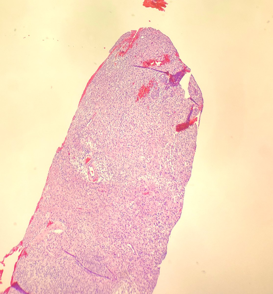 JShowMD's tweet photo. What’s the difference in these? Patient age for one: one is from a 64 year old male and the other is from a 34 year old male. molecular pending on the 34 yo but the older gentleman was IDH wild type. older gentlemen in the later 2 photos. #pathology #neuropathology https://t.co/kBgz4ZGzsg