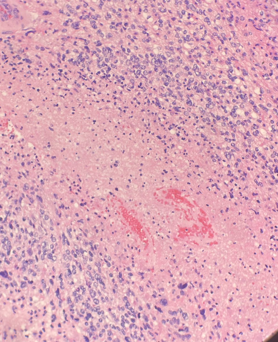 JShowMD's tweet photo. What’s the difference in these? Patient age for one: one is from a 64 year old male and the other is from a 34 year old male. molecular pending on the 34 yo but the older gentleman was IDH wild type. older gentlemen in the later 2 photos. #pathology #neuropathology https://t.co/kBgz4ZGzsg