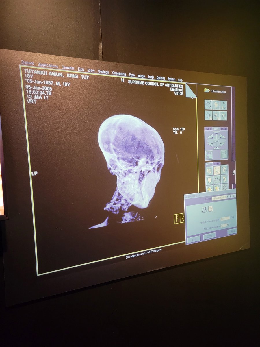 RadCLARITe's tweet photo. HIPAA only applies for 50 years after death apparently. King Tut was 19 when he died around 1324 BC. The power of Computed Tomography! #ISCTrad https://t.co/AAaCRJfLCJ