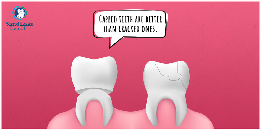 SandLakeDentist's tweet image. Restore your cracked teeth with our quality dental caps. 😃 #DentalCaps #TeethCaps #Caps #DentalTreatment #DentalHealth