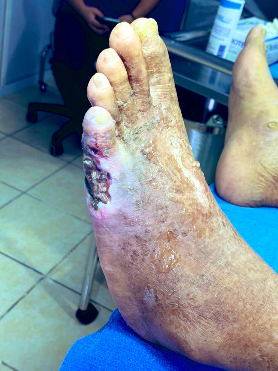 These pictures shows a combined mixed devastating Diabetic Foot Attack (DFA) including, infection, edema, neuropathy and ischemia. SEWSS | Saint Elian Grade III scoring 23 points. The Stage III threat with a very high risk for a new DFA, amputations, or death.