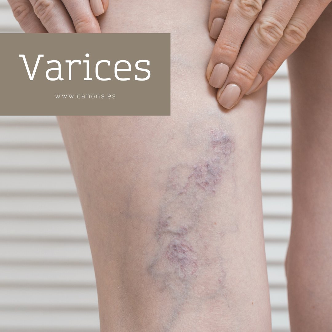 canonsclinics's tweet photo. El láser vascular es un tratamiento médico estético digirdo a eliminar lesiones vasculares tanto en rostro como en cualquier parte del cuerpo de forma ambulatoria y segura. 

En Cànons disponemos del sistema de Láser Médico @cuteraspain #ExcelHR que garantiza resultados exitosos. https://t.co/iyD3iuA8ff