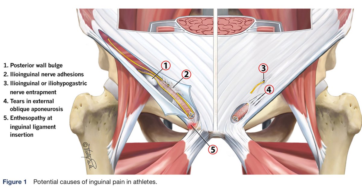terapiamanualUE's tweet photo. GROIN PAIN! Tratas deportistas con dolor inguinal relacionado con el canal inguinal sin presencia de hernia? Este concenso de expertos puede ayudaros en vuestro razonamiento clínico para evaluar y tratar correctamente este tipo de patologías. OPEN ACCESS!!
https://t.co/yNT4kTTWSf https://t.co/F8JFDu4VOC