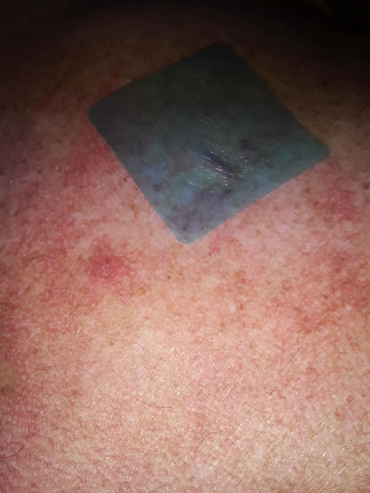 PeterMcIntyre50's tweet image. the Voxxlife REM-patch Sleep  Warning the Use by Date, @voxxlife #Voxxlife   You have stated the patch is GOOD for another year! so 2022 to @2023   So @2023 till 2024 ? Thats 2 years after the use by DATE! PS  the #REMPatch  #Rash