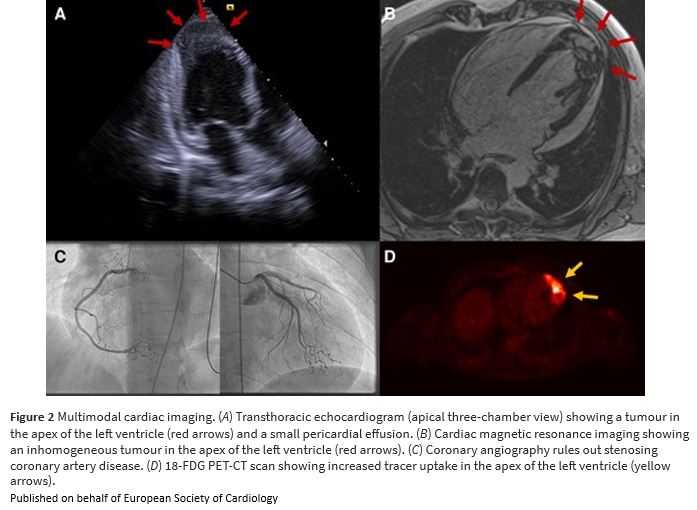 European Society of Cardiology Journals (@esc_journals) on Twitter photo Cardiac relapse of extranodal NK/T-cell lymphoma manifesting as incessant ventricular tachycardia academic.oup.com/ehjcr/article/âŠ
#EHJCaseReports #EPeeps <a href="/aayshacader/">Aaysha Cader</a> <a href="/ANazmiCalik/">A.Nazmi Calik</a> <a href="/KardiologieHH/">Erik Rafflenbeul</a> <a href="/TJ_Yeo/">Tee Joo YEO</a> <a href="/EHJCREiC/">EHJCaseReports Editor-in-Chief</a> <a href="/cfcamm/">Fielder Camm</a> <a href="/FarhanaAra/">Farhana</a> #YesCCT #EchoFirst #ImageFirst #wyhCMR Cardiac relapse of extranodal NK/T-cell lymphoma manifesting as incessant ventricular tachycardia academic.oup.com/ehjcr/article/âŠ
#EHJCaseReports #EPeeps <a href="/aayshacader/">Aaysha Cader</a> <a href="/ANazmiCalik/">A.Nazmi Calik</a> <a href="/KardiologieHH/">Erik Rafflenbeul</a> <a href="/TJ_Yeo/">Tee Joo YEO</a> <a href="/EHJCREiC/">EHJCaseReports Editor-in-Chief</a> <a href="/cfcamm/">Fielder Camm</a> <a href="/FarhanaAra/">Farhana</a> #YesCCT #EchoFirst #ImageFirst #wyhCMR