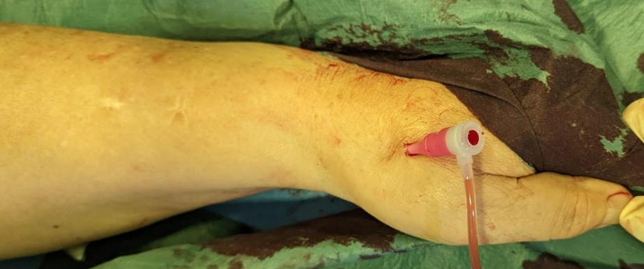 drjunjieng's tweet photo. Loving the distal radial artery (snuffbox) approach for endovascular treatment of dysfunctional AV access! Advantages: single access to treat inflow and outflow lesions, easy haemostasis and you can avoid hand radiation during the procedure! #vascularsurgery #vascular #godistal https://t.co/V0Mbe3xW30