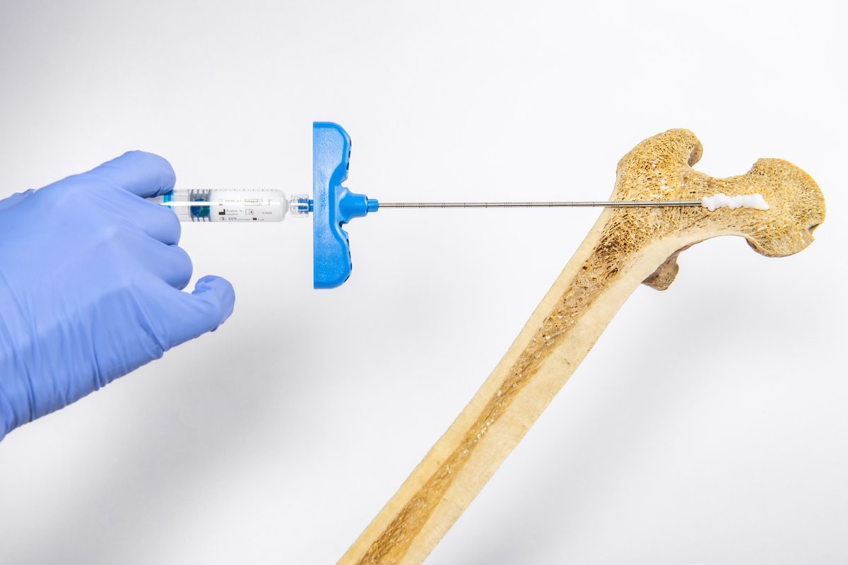 startupEPFL's tweet photo. Congratulations 👏 @Flowbone #EPFLStartup for the seed round of CHF2.1 million in order to bring nanomedicine-based bone repair to the market https://t.co/0row3TeYNA #Innogrant @EPFLEngineering https://t.co/suGGhnFFda