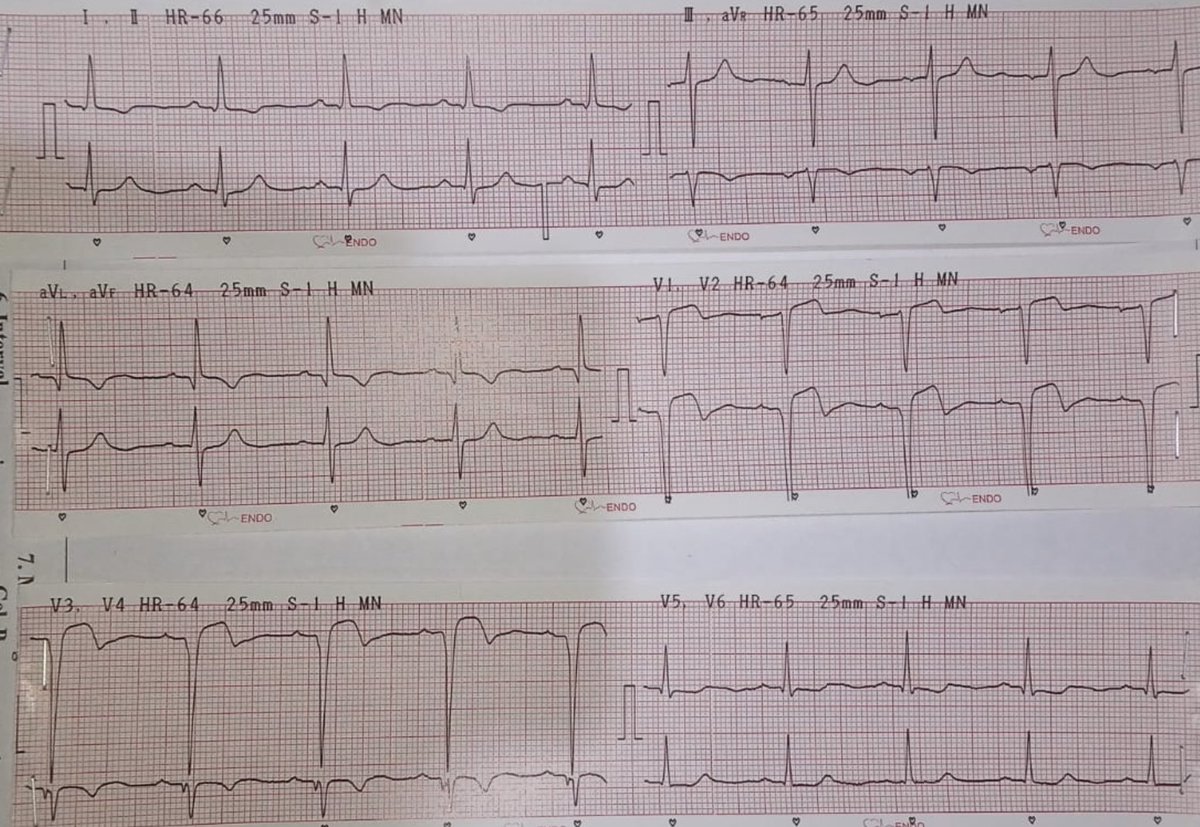 Pria 40an th datang ke klinik dgn keluhan nyeri dada dan sesak jika beraktivitas

1 bln sebelumnya nyeri dada hebat, ke igd diminta rawat o/ dokter tapi menolak dengan alasan tidak punya biaya n jaminan

Faktor risiko merokok 2 pack/hari

EKG: