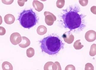 *_Hairy cell leukemia:*_ 
This is rare Chronic B-Cell lymphoproliferative disorder.
▪ male to female ratio is 6:1 & median age at diagnosis is 50 years.
▪ all patients with Hairy cells leukemia have been found to have a _mutation_ in  the _BRAF_ gene.

▪ *presenting Symptoms