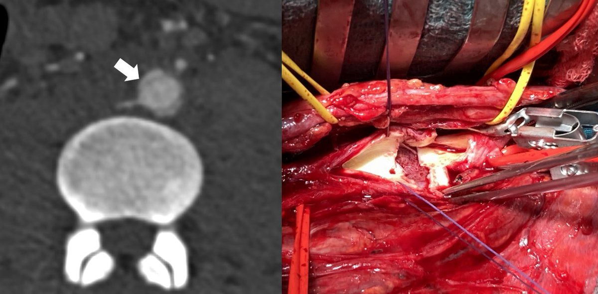 UszVascular's tweet photo. Blunt abdominal #trauma and resulting #transection of the infrarenal #aorta. Complete intimal laceration. Due to the young age of the patient, #opensurgery was performed.
#aorted #vascularsurgery https://t.co/cN44ddrA0F