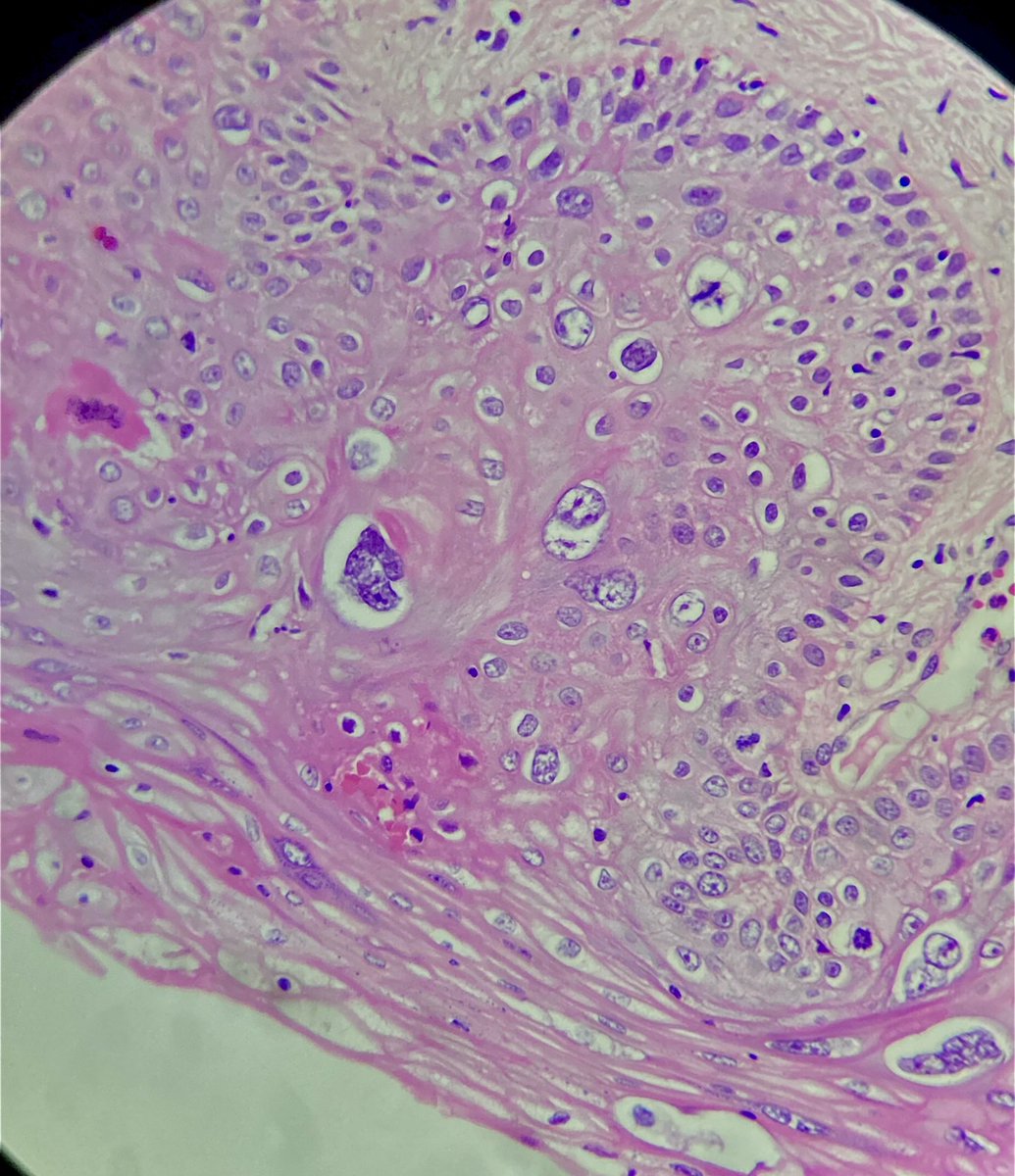 ClevesMario's tweet image. Cervical biopsy. Squamous intraepithelial lesion. What’s the grade? Why?
.
.
.

#medicine #anatomy #medschool #pathology #histology #medlife #histologia #path #pathologists #oncology