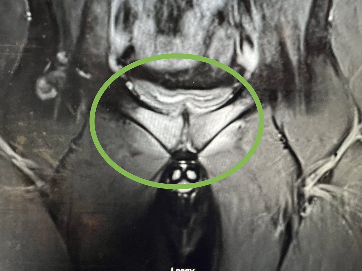 Florid pubic and rami bone oedema in a footballer in his 20s, male. I was asked to exclude sportsman’s hernia. 

Loading and training history essential and identify any other risk factors eg dietary changes, weight loss/gain.

Can often predict level of overload from Hx and Ex.