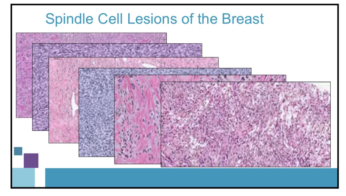 Jenny Pincus, MD (@jennpincus) on Twitter photo It was a great session on breast biopsies with spindle cell lesions from <a href="/CollinsLauraC/">Laura Collins</a> and <a href="/LizaMQuintana/">Liza Quintana, MD</a> this morning. This picture is from <a href="/CollinsLauraC/">Laura Collins</a> & beautifully demonstrates how diverse they can be! Hope to see you at the session this afternoon! #cap22 #breastpath It was a great session on breast biopsies with spindle cell lesions from <a href="/CollinsLauraC/">Laura Collins</a> and <a href="/LizaMQuintana/">Liza Quintana, MD</a> this morning. This picture is from <a href="/CollinsLauraC/">Laura Collins</a> & beautifully demonstrates how diverse they can be! Hope to see you at the session this afternoon! #cap22 #breastpath