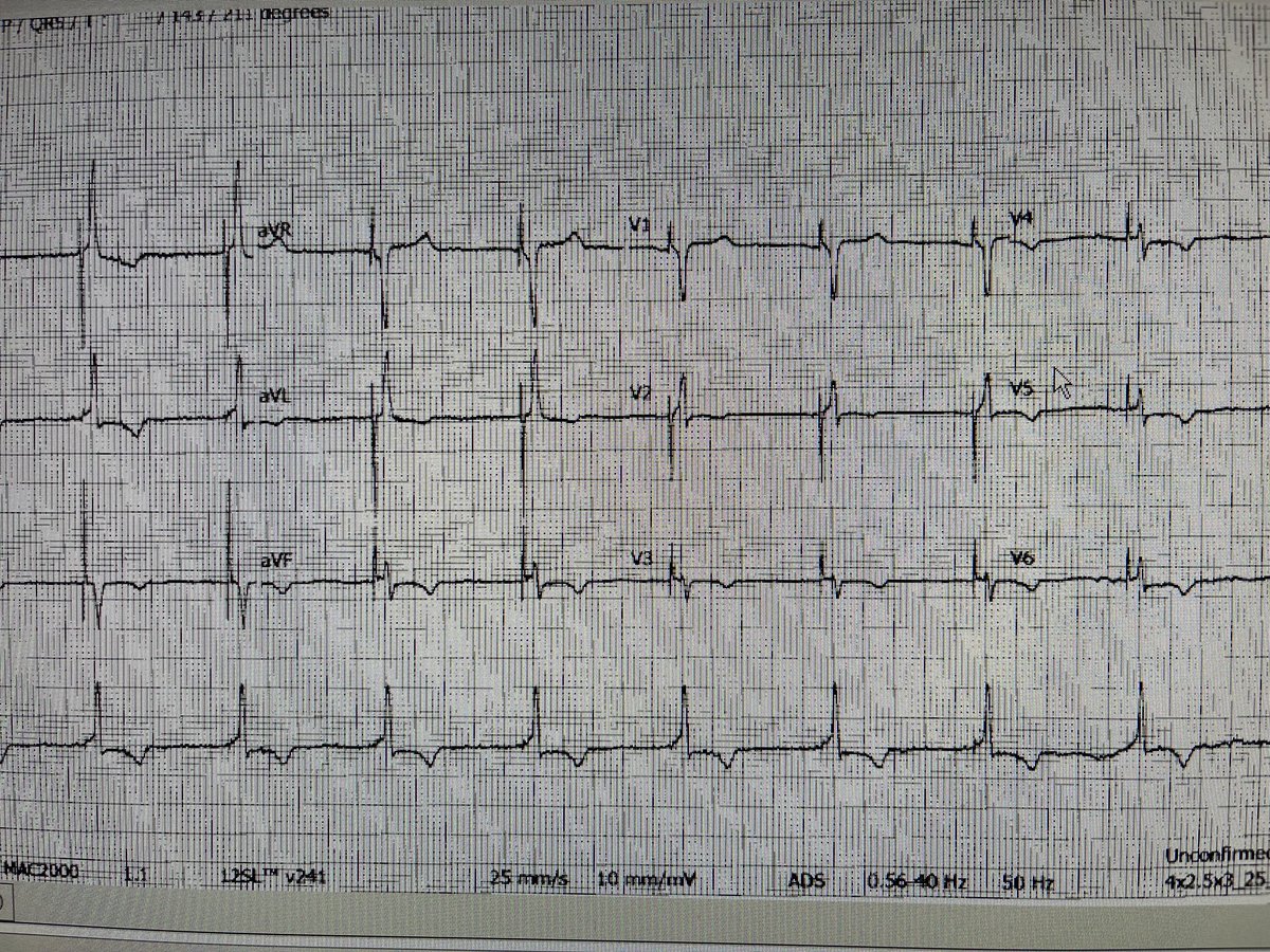Patient with prior cs lead since 2017. Ef never responded (25%) corrective conduction system lead in august. Now 55%. Nyha class 2-3 to now exercising at the y. Dont dis the his!! #epeeps