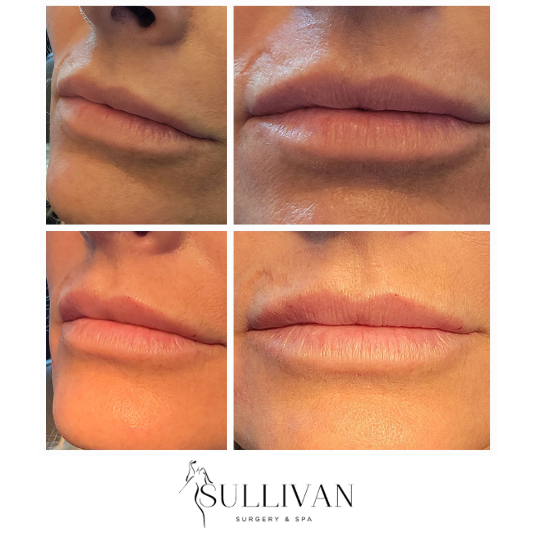 Sullivan1K's tweet photo. Before and after a subtle lip filler.

It doesn't have to be a dramatic result. 

A subtle fill can restore a hydrated affect to the lips and fill the fine lines that develop as we lose volume over time.

#lipfiller #lips #aesthetics #botox #beauty #dermalfillers #lipinjections # https://t.co/jTWLi8pMHq