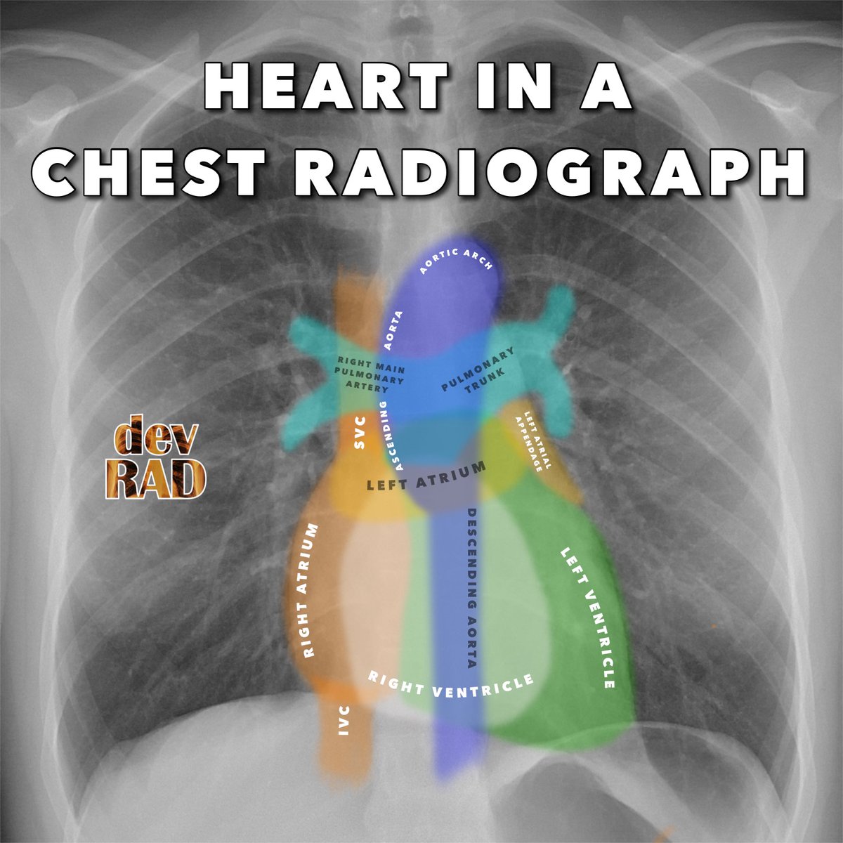 Chest Radiograph Anatomy
h/t @drdevrad
#radiotwitter #raded #meded #medtwitter