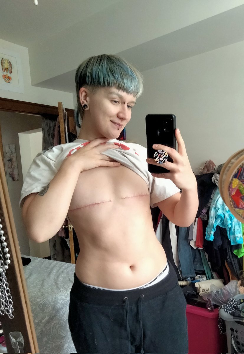 AstroXed's tweet photo. I know I haven't been active on here in awhile buuuut 

-it's my birthday!!!! send me a bday tip?? 🥺 $AstroXed

-I'm about 10 wks post top surgery!!! This pic is messy but I rly wanted to share with y'all. I feel so much happier in my body. https://t.co/dgh2eTUSHS