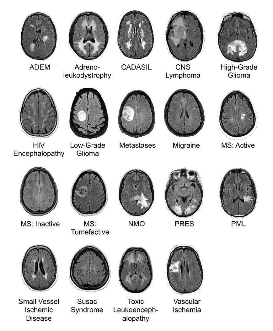 Common brain lesions on FLAIR MRI
#radiotwitter #meded #medtwitter
