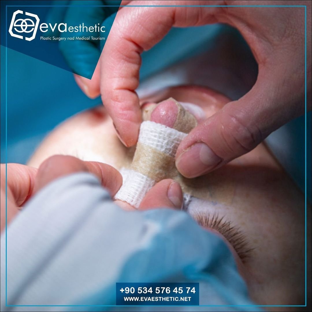 Rhinoplasty with talented experts at Eva Esthetic 
#rinoplastiistanbul in #evaesthetic
.For more information about rhinoplasty at Eva-Esthetic Hospital, you can contact the medical staff to get free medical advice:
💯WhatsApp Dercet: (bit.ly/2T3QtuF) 🌏 #plasticsurgery
