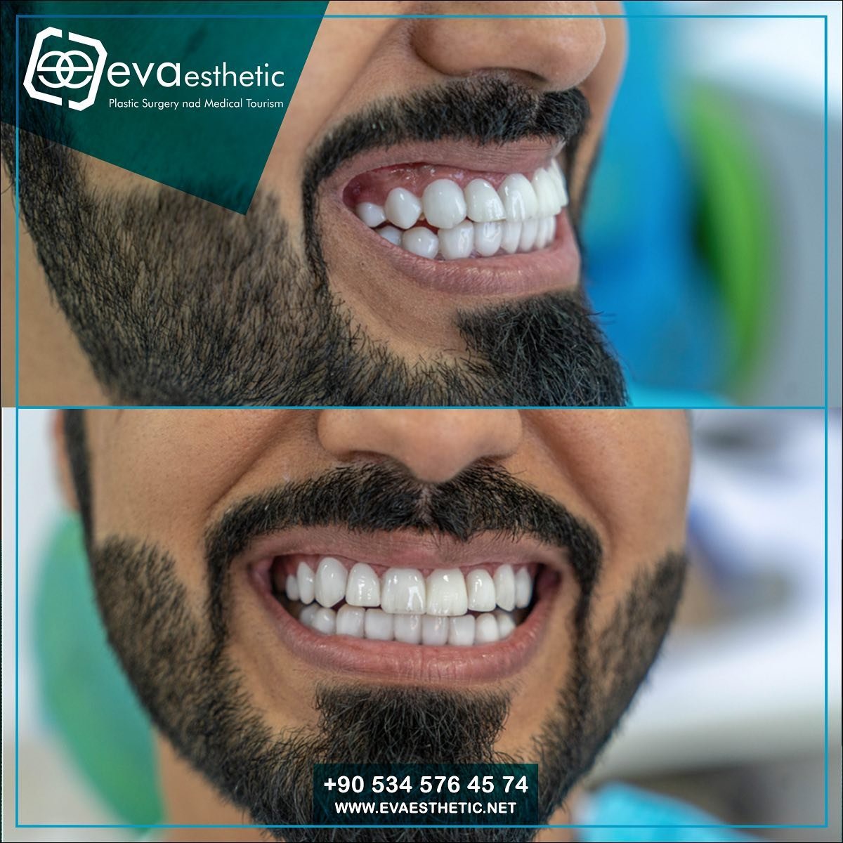 #hollywoodsmile in evaesthetic 💯
At Eva Aesthetic, we guarantee the success of the operation
For more information about hair transplantation at Eva-Esthetic Hospital, you can contact the medical staff to get free medical advice:
💯WhatsApp Dercet: (bit.ly/2T3QtuF) 🌏