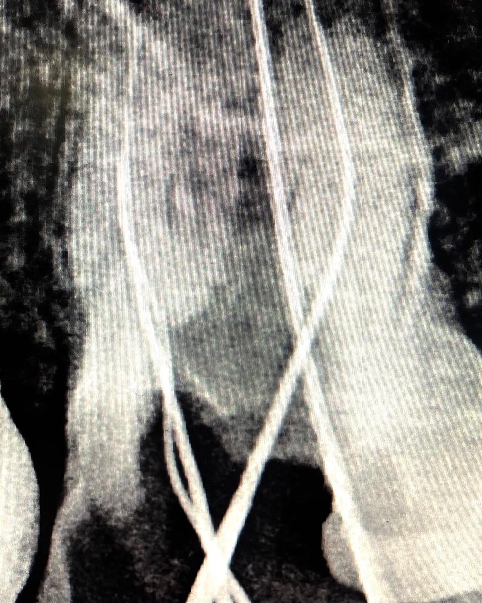 drpmdfuentes's tweet photo. Empezamos la #semana con #endodoncia en #pieza26 de #4conductos #multirradicular ☝️☝️Tratamiento con #protapernext y #obturacion con #gutaperchatermoplástica y #calamusdual en @sanitas #dresquerdo @_clinicadental ¡Ayudar al #paciente la mejor forma de arrancar la semana! 🦷 https://t.co/1zXGzeMdeG