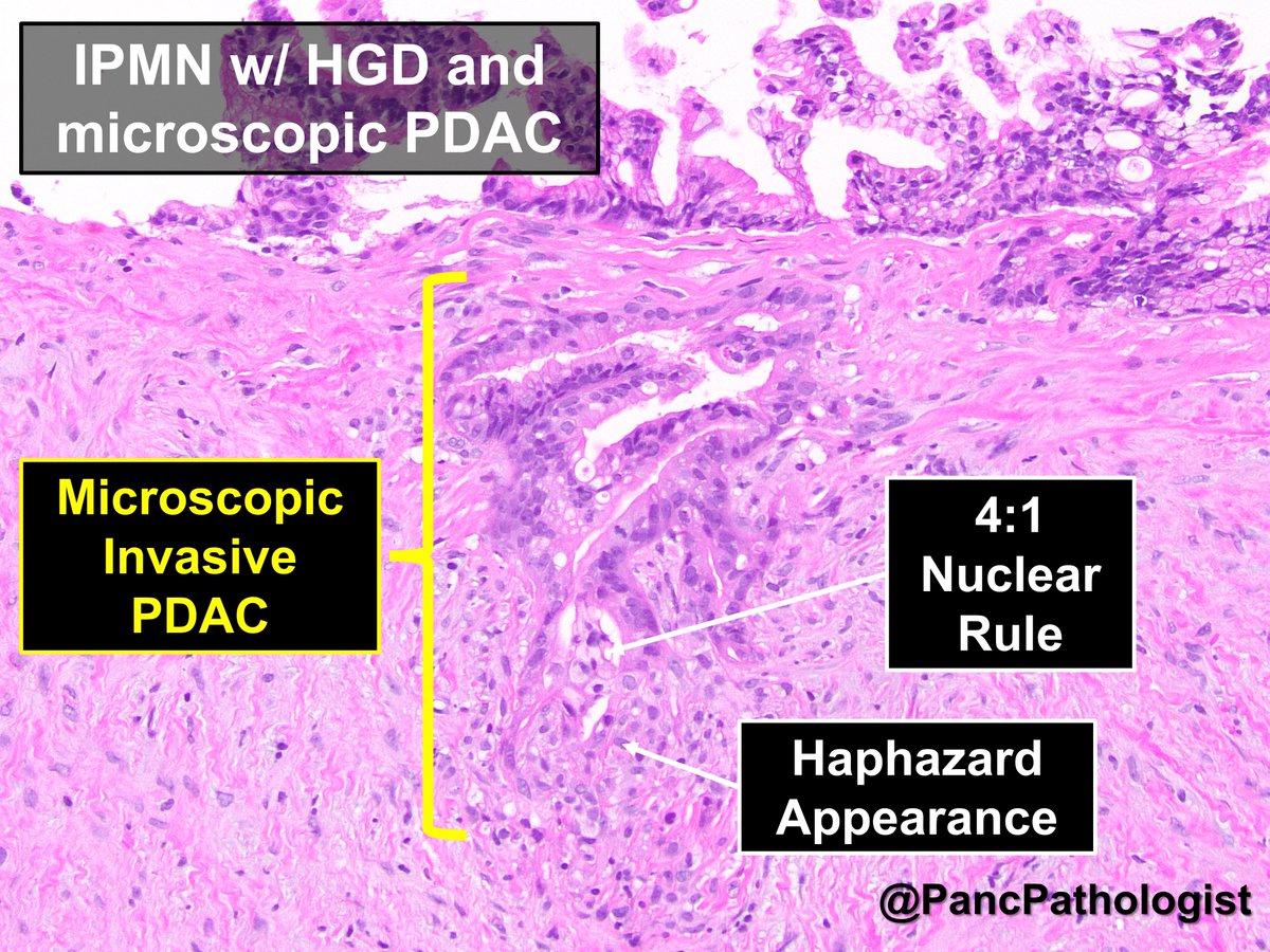 A tweetorial on our study (gastrojournal.org/article/S0016-…). But, first a case: Young female w/ a 1.9 cm incidental pancreatic cyst. No concerning features, but KRAS, TP53 and SMAD4 mutations on molecular testing. Surgical resection: #IPMN w/ a small #PancreaticCancer. #Pathology #GIPath