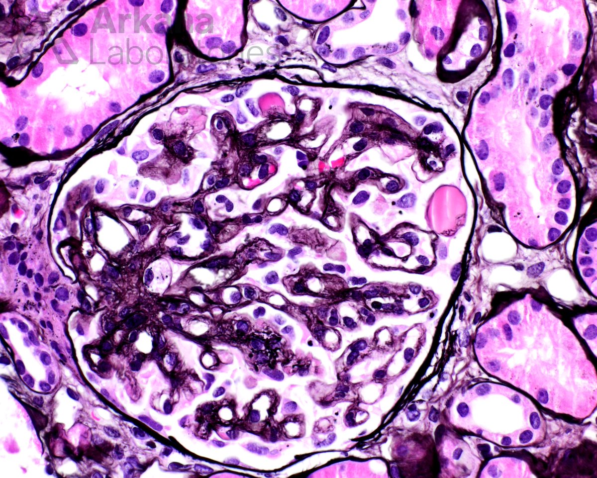 arkanalabs's tweet photo. This is the biopsy of a 47-year-old female with cervical cancer, on anti-VEGF therapy, with proteinuria and normal renal function. IF was negative. #renalpath #NephTwitter

What is your diagnosis? https://t.co/sN6IfZmxHT