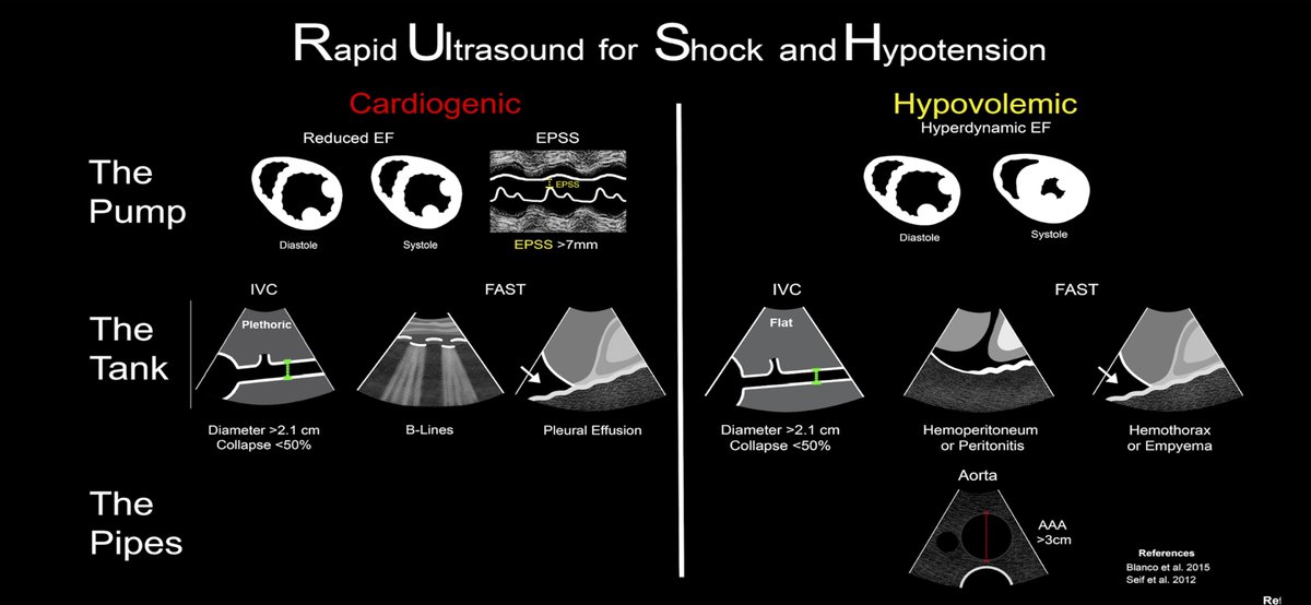dan___kim's tweet photo. More cards from @ACEP_EUS critical care subcommittee. This set is on the RUSH protocol and different shock patterns.
#echo #echofirst #POCUS 
https://t.co/LhO8RuQpRE https://t.co/peBuLIBxcn