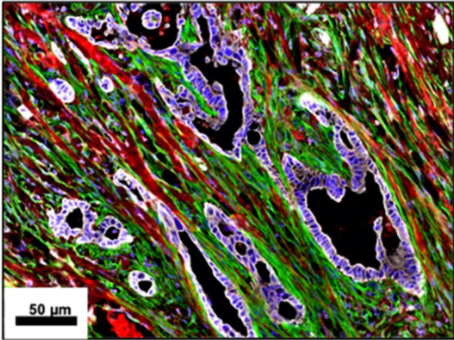 Congratulation to Prof Cindy Neuzillet Periostin- and podoplanin- positive cancer-associated fibroblast subtypes cooperate to shape the inflamed tumor mic… pubmed.ncbi.nlm.nih.gov/36102377/ #fibroblast #cancer