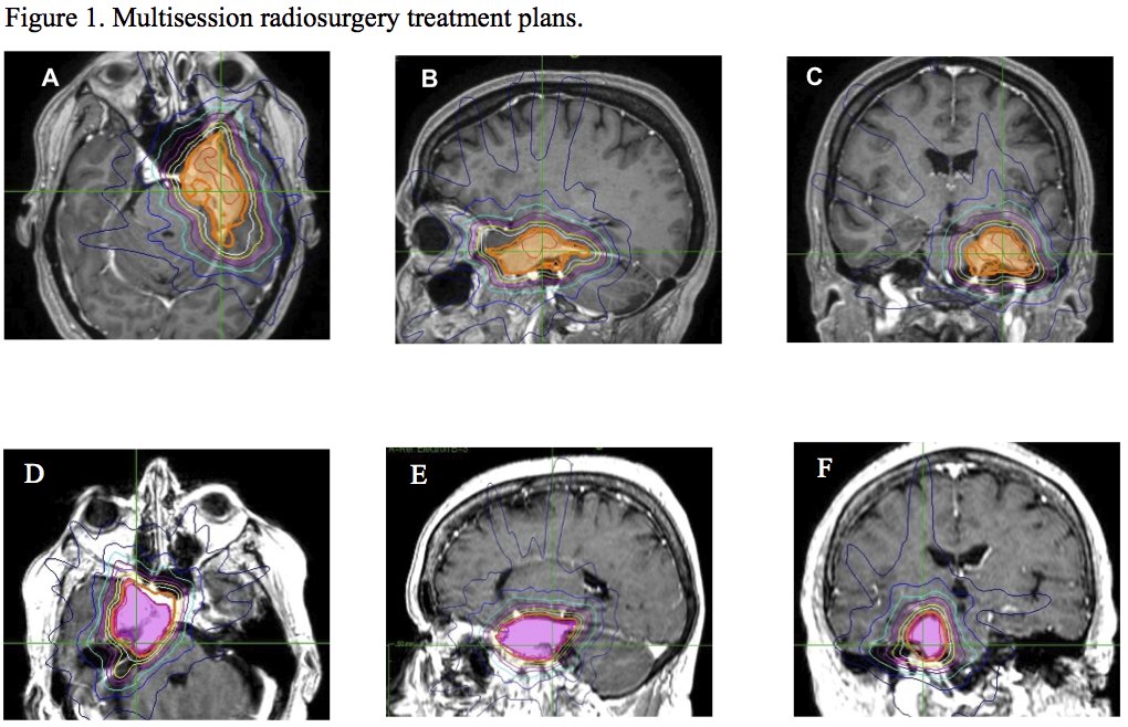 ASTRO_org's tweet photo. #RedJournal: "Hypofractionated Radiosurgery for Large or in Critical Site Intracranial Meningioma: Results of a Phase II Prospective Study" @valentinapinzi https://t.co/Q2f4Kb1keM https://t.co/hE2DBNr011