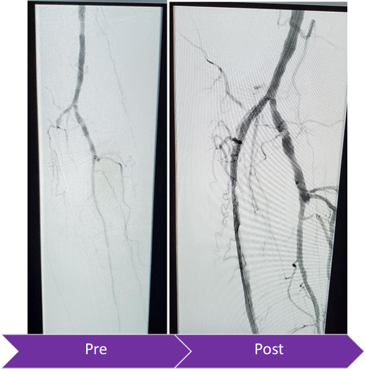 bsc_vascular's tweet image. Congratulations and thank you to @RicardoBCardiel, @surgmax, and the entire team at Presbyterian Hospital for a successful FIRST Peripheral #ROTAPRO Case! #CLTI