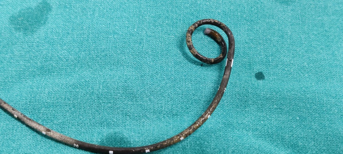 docsharadshah's tweet photo. @cookuro @the_stents @Endo_Society @so_uro @DrPNMaheshwari    cook's black silicone stent for 2years, retained due to pandemic lockdown,CT shows clean stent no encrustation. On quick, smooth removal stent shows very fine white deposits only on vesica end.Wonderful Cook.. v.useful https://t.co/oB5qYQlPCL
