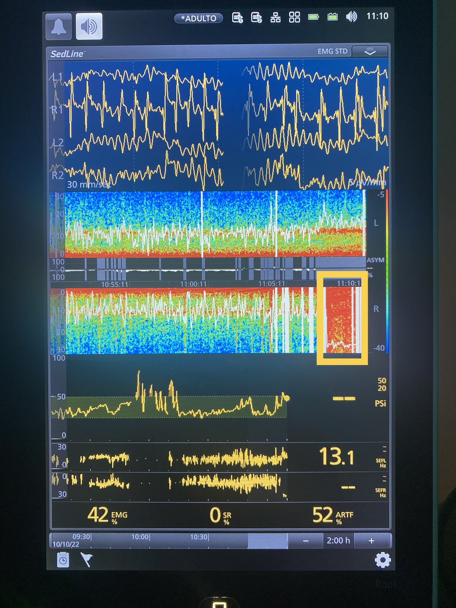 steph_heres's tweet image. Female 41 years old, with right hemifacial spasm, microvascular decompression surgery.  During decompression there is stimulation of the facial nerve that we see like this in the spectrogram... #neuroanesthesia #EEGmonitoring