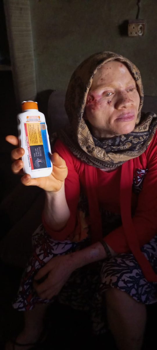 ProudlyAlbinism's tweet photo. Madam Oluchi Chibuike is a person with albinism currently battling with chronic malignant skin cancer. She needs serious medical attention. To help her please kindly contact us for more details 07011008096
#PeterObi4President2023
#ASUUstrike
#BBNajiaS7
#BidenDeliversAGAIN
#nija https://t.co/1O9Hx1tFhs