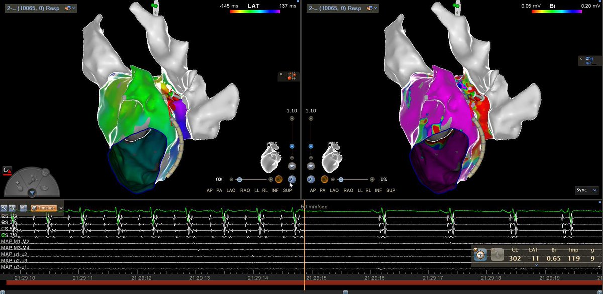 Daniel Matos (@danielm891) on Twitter photo Atrial flutter with critical isthmus in the LSPV ridge, mapped with #octaray and treated with #qdot. Conversion to SR during ablation! #padragao #pgalvaosantos <a href="/JoanaPinho92/">Joana Pinho</a> @BiosenseWebster #EPs #HospitalSantaCruz Atrial flutter with critical isthmus in the LSPV ridge, mapped with #octaray and treated with #qdot. Conversion to SR during ablation! #padragao #pgalvaosantos <a href="/JoanaPinho92/">Joana Pinho</a> @BiosenseWebster #EPs #HospitalSantaCruz