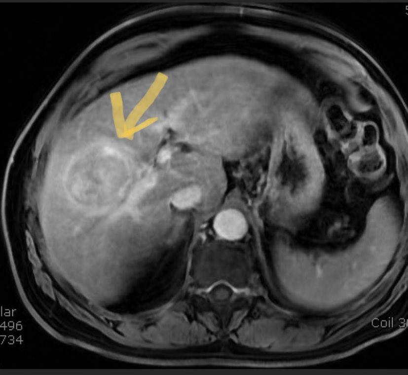 Jkhileman's tweet photo. What this product can do in the hands of #irads to help treat #livercancer patients inspires me every day. #TheraSphereDa90Ys #ManyMilestones1TheraSphere https://t.co/WFKYYmYWEh